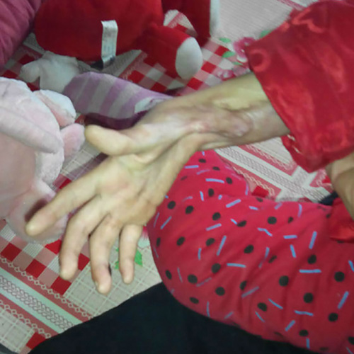 妤心植皮后，出现了非常严重的疤痕增生现象